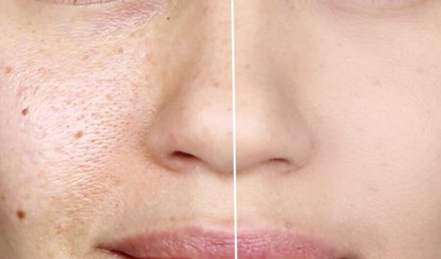reducing facial pores 