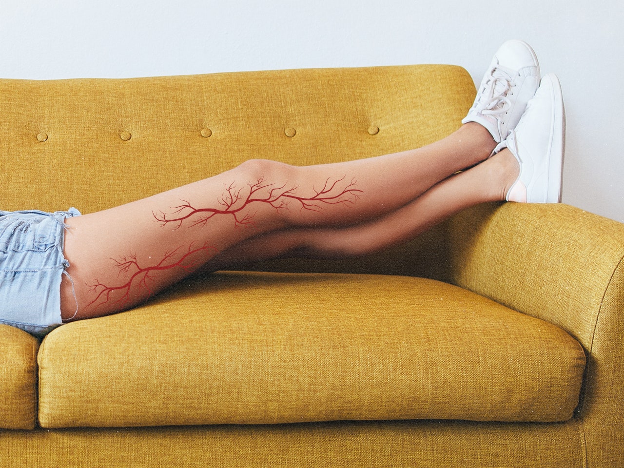 Menopause and Spider Veins: The Connection